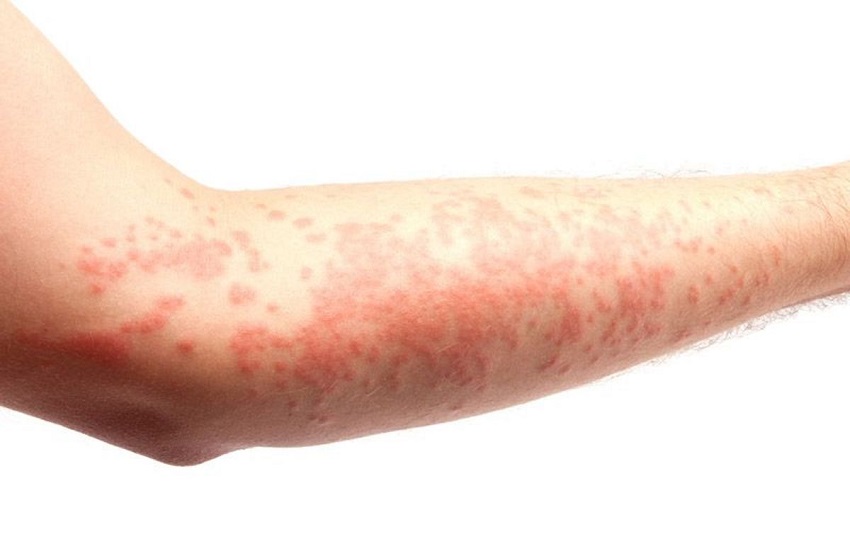 5 Most Dangerous Rashes in 2022